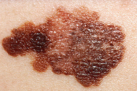 Melanoma