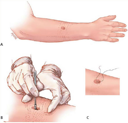 biopsia