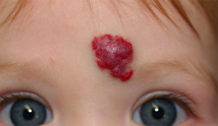 hemangioma